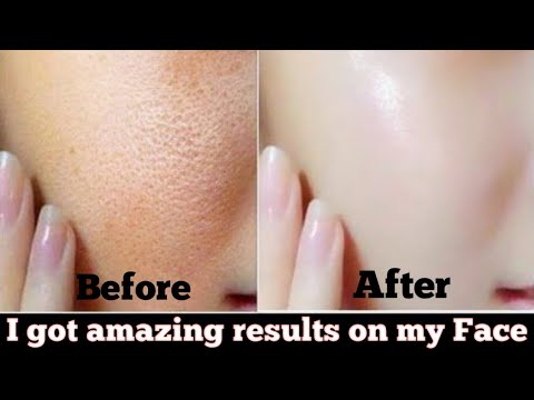 I got amazing results on my skin || How to get clear skin || Glass skin ...