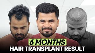 Hair Transplant in Ahmedabad (HX-AFFA) | Best Results & Cost of Hair Transplant in Ahmedabad.