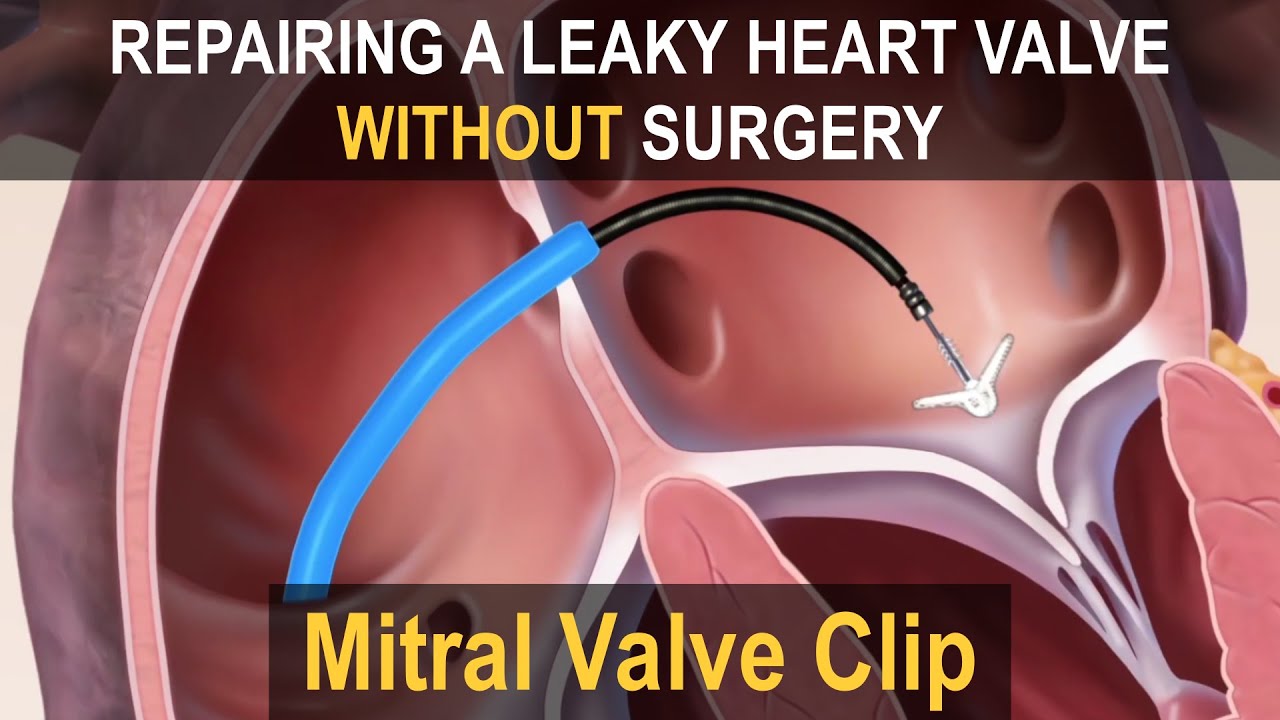 MITRACLIP Mitral Valve Clip  Repairing a Leaky Heart Valve without Surgery