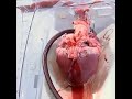 DM #104 - Heart transplant
