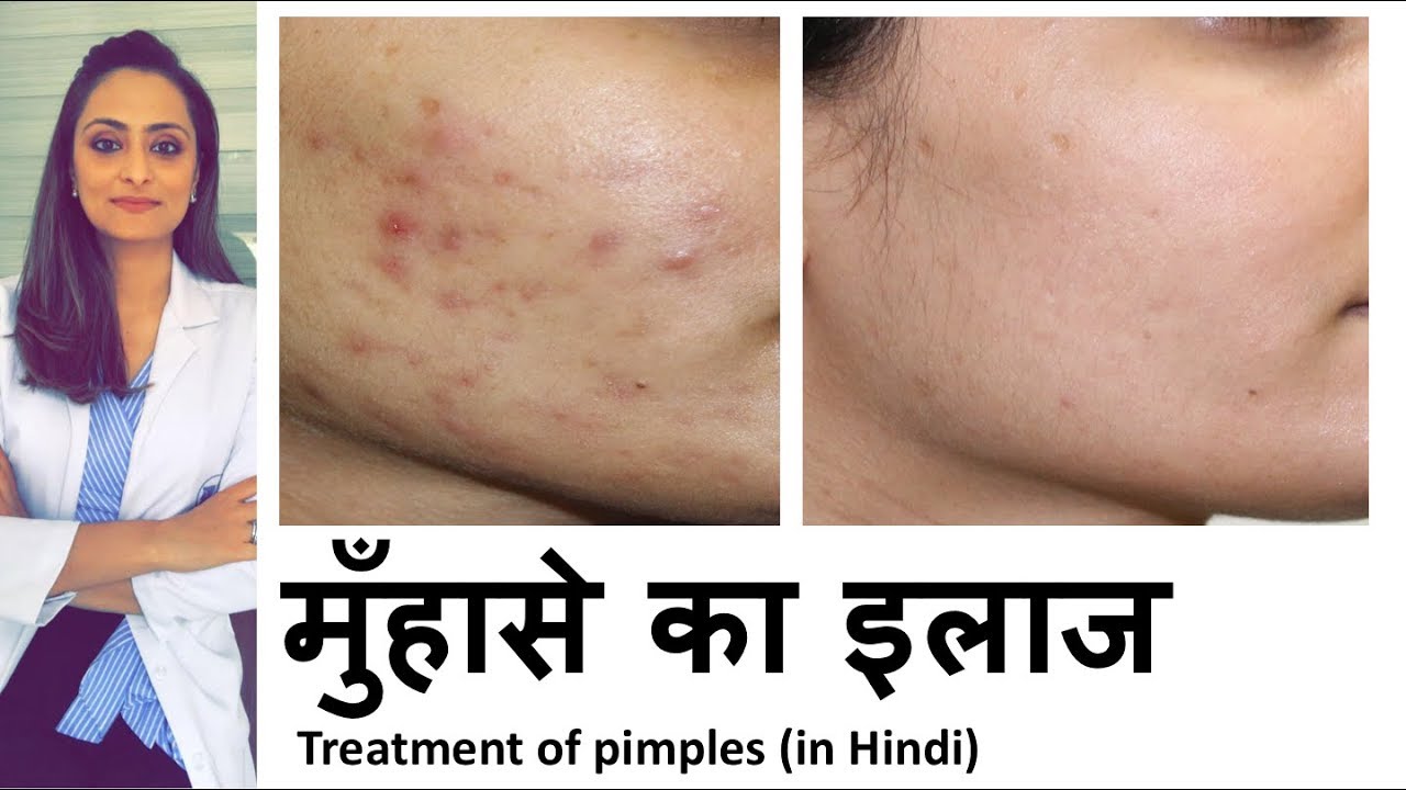मुहासे की इलाज | How to Treat Pimples: Different Medicines and How to
