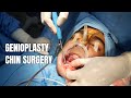 Surgical Video on Genioplasty - Dr. Sunil Richardson