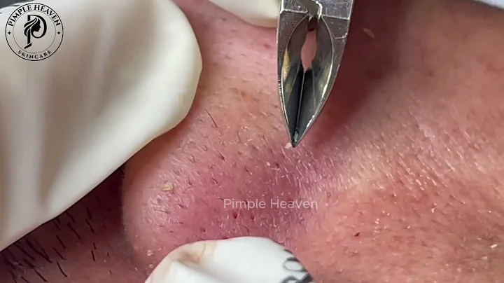 Blackhead Removal on Nose with Tweezers — So Satisfying