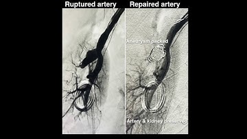 DISSECTING RENAL PSEUDOANEURYSM