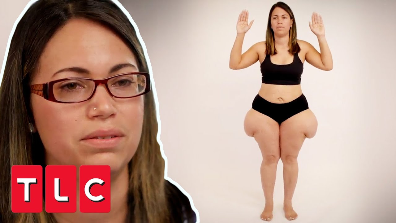 Her Hips TRIPLED In Size After Giving Birth To 8 Kids | Awake Surgery