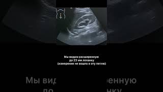#узи #гидронефроз