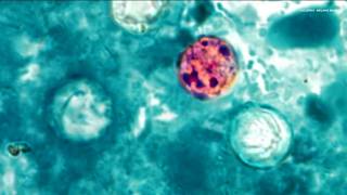 The Cyclospora outbreak and whether Minnesotans should be concerned