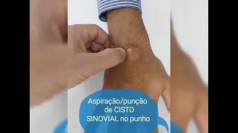 Como desmanchar cisto sinovial?