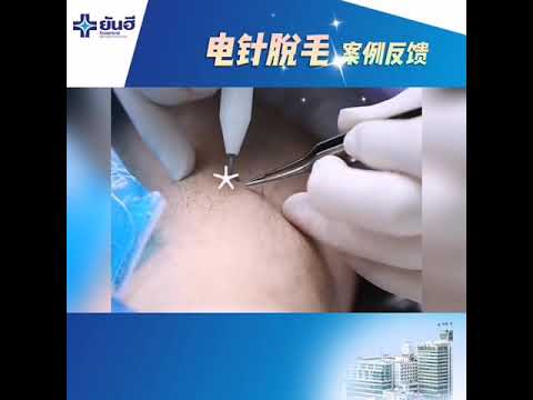 Yanhee电针脱毛（electrolysis）反馈