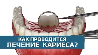 Лечение кариеса: этапы лечения кариеса(, 2015-06-13T00:22:36.000Z)