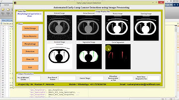 Lung Cancer Detection Using Image Processing Matlab Project with Source Code