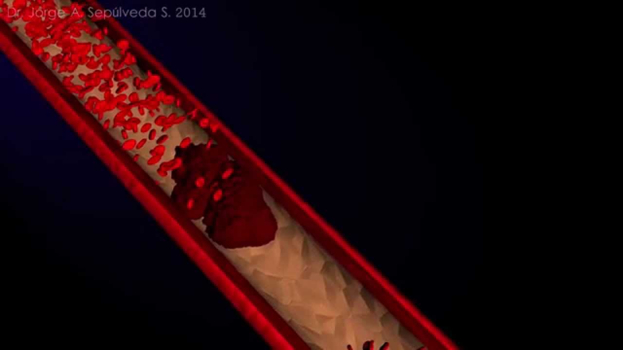 Electrocardiografía Básica (Parte 4/4)