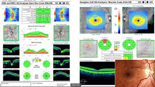 OPTICAL COHERENCE TOMOGRAPY (OCT) MACULA INTERPRETATION