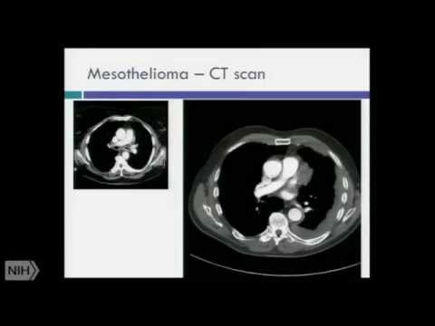 Kansas City Mesothelioma: Vimeo's Untold Story Will Shock You