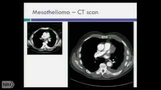 What is mesothelioma- 2014 - 2015 Symposium