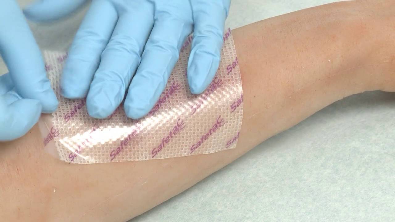 How to apply Mepitel® 