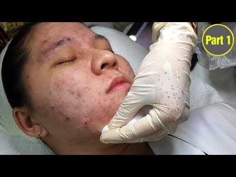 Video Cách điều trị mụn hiệu quả cho da bị nhiễm corticoich... - youtube