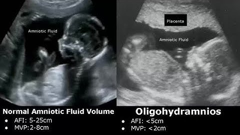Obstetric Ultrasound Normal Vs Abnormal Images | Fetal, Placenta, Umbilical Cord Pathologies USG