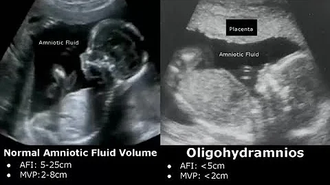 Obstetric Ultrasound Normal Vs Abnormal Images | Fetal, Placenta, Umbilical Cord Pathologies USG