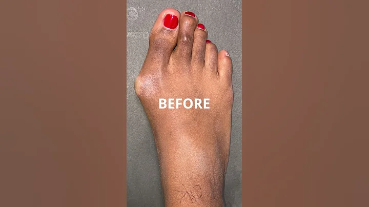 Bunion GONE in Just 47 Seconds! 😱 #bunions #foothealth - DayDayNews