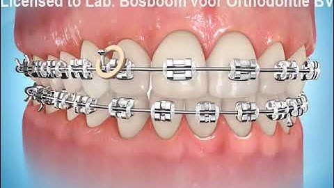 Elastics Midline Correction
