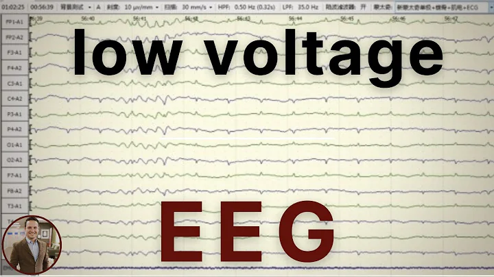 Low-Voltage EEG Explained | Traumatic Brain Injury and Abnormal EEG Patterns
