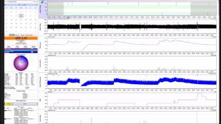 Rem Specific Apnea And Problems With Apap Therapy. Interpret Sleep