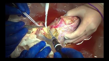 Ex Vivo Liver Resection
