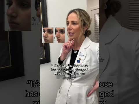 Video thumbnail: Straighten your nose in 15 minutes with no downtime!