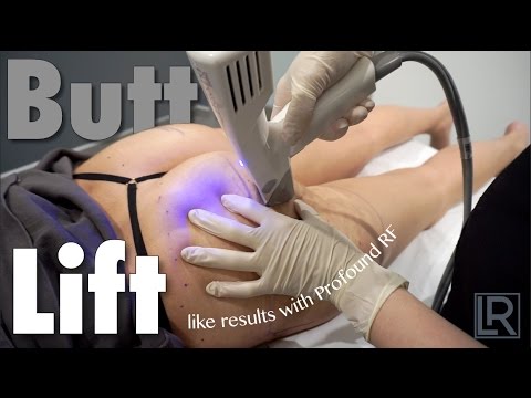 BUTT LIFT Results with Profound RF Non-Surgical Procedure 