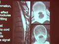 Imaging Patients with Myelopathy