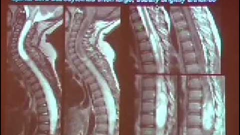 Imaging Patients with Myelopathy