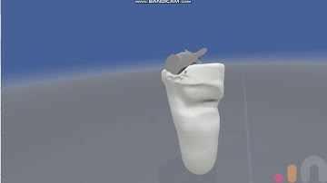 Above Knee prosthetic modifications with Oculus Medium - IC stamp cut