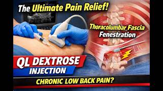USG Guided QL Muscle 5% Dextrose Injection & Thoracolumbar Fascia Fenestration |Chronic LowBackPain USG Guided QL Muscle 5% Dextrose Injection & Thoracolumbar Fascia Fenestration |Chronic LowBackPain