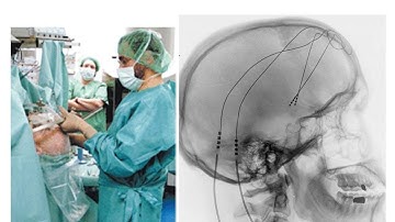 Repairing and Treating Damaged or Dysfunctional Brains - Professor Keith Kendrick