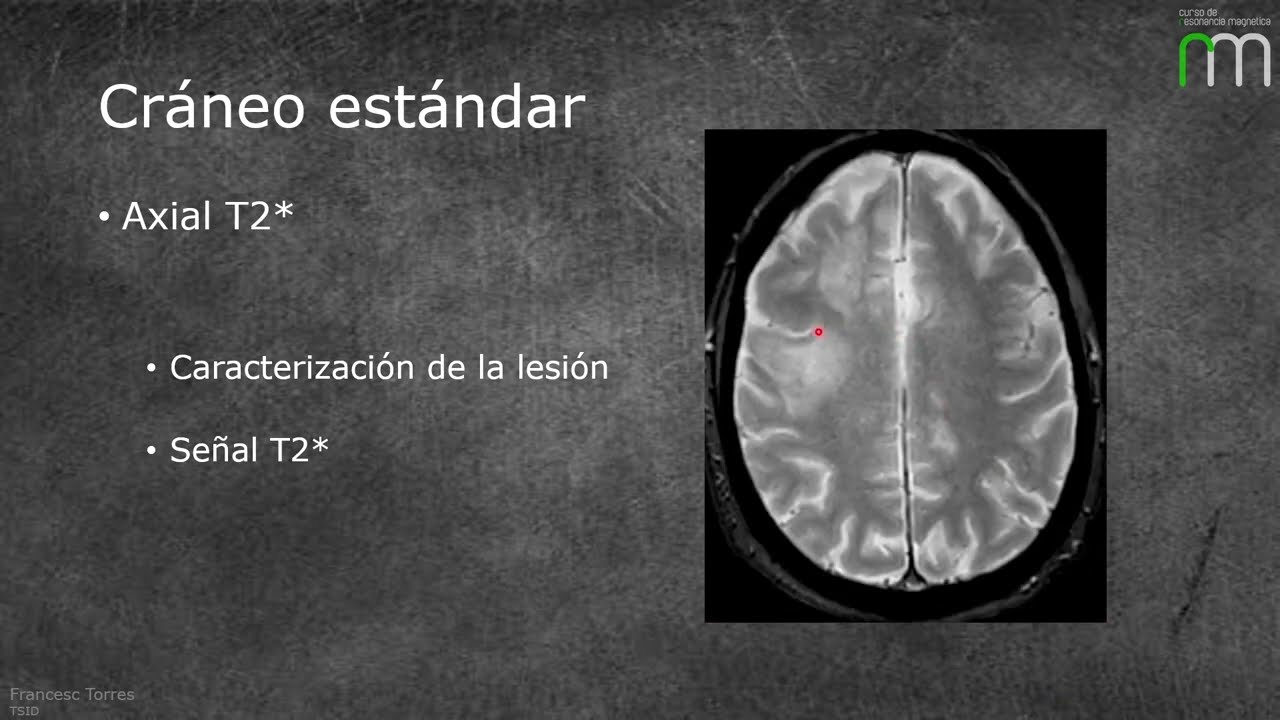 RMmp cerebral