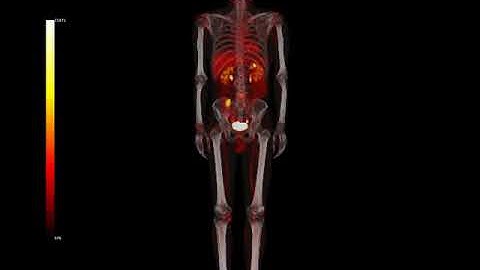 Fusion MIP (Maximum Intensity Projection) PET-CT