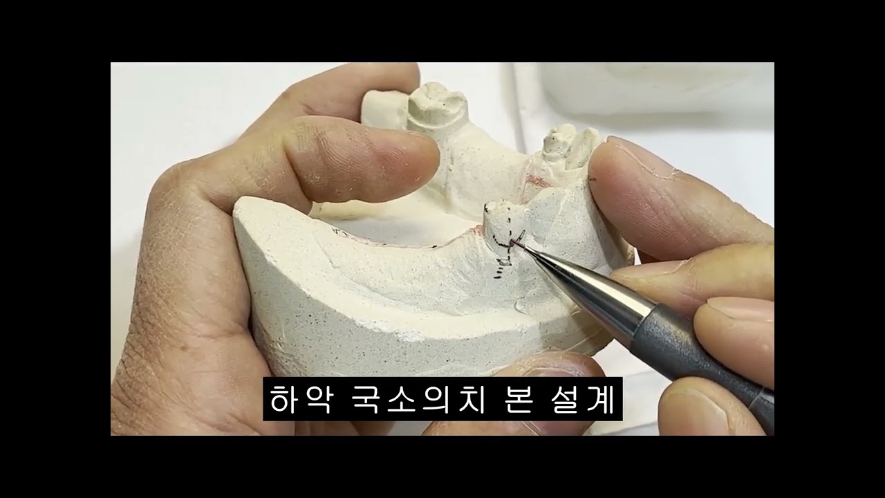 9  하악 국소의치 본 설계10분 26초
