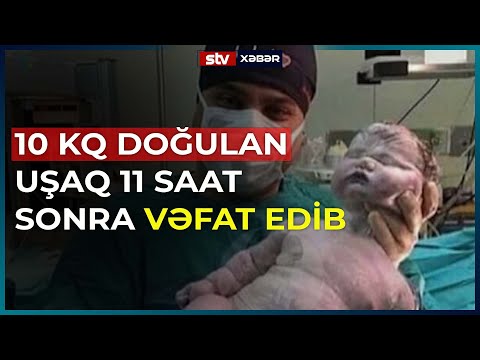 10 KQ DOĞULAN UŞAQ 11 SAAT SONRA VƏFAT EDİB