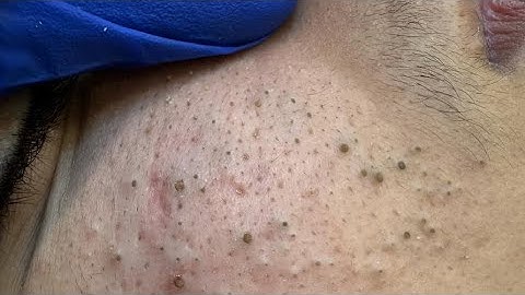 [ASMR] Blackhead And Whitehead Removal, Relaxing Deep Facial Cleansing Routine