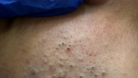 [ASMR] Relaxing Blackhead Extraction and Facial Cleansing for Clear Skin