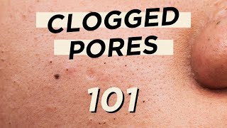 🤭Everything you need to know about CLOGGED PORES • Skincare & makeup products are not the culprit screenshot 2