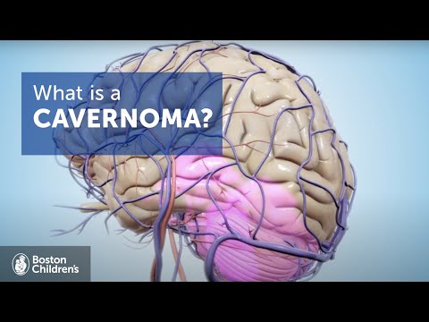 Brain Cavernous Malformation (CM) | Boston Children&rsquo;s Hospital