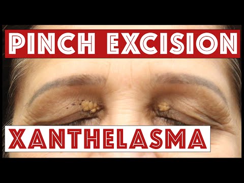 Removing Xanthelasma On The Upper And Lower Eyelids