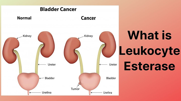 What does it mean when you test positive for leukocytes and negative for nitrite