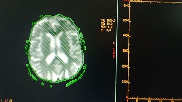 MRI Brain perfusion post processing