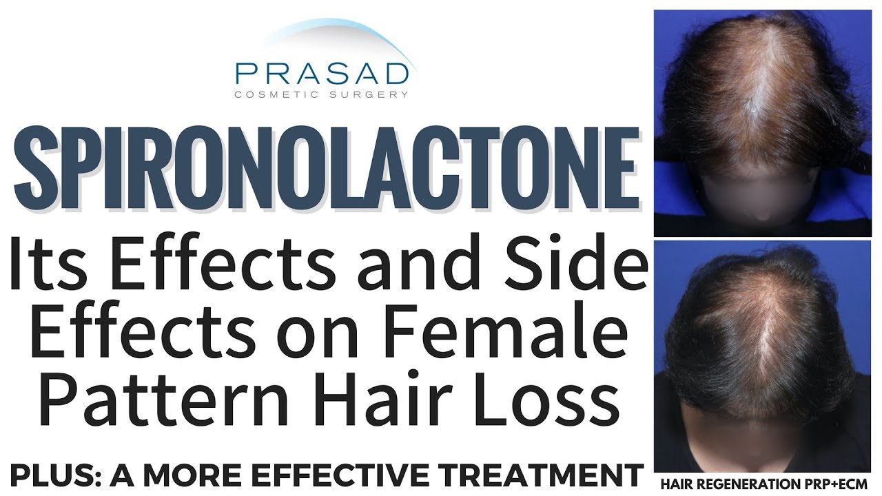 Effects of Spironolactone on Female Pattern Hair Loss and Kidneys, and a  More Reliable Treatment - thptnganamst.edu.vn