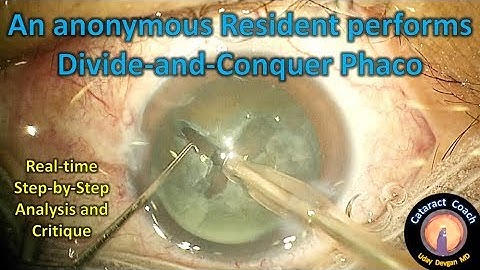 learning from a resident surgeon performing divide and conquer cataract surgery