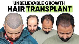Hair Transplant in Roorkee (HX-VXVG) | Best Results & Cost of Hair Transplant in Roorkee