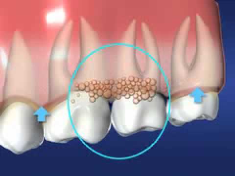 Wideo: Wykresy Dentystyczne I Przyzębia: Cel I Procedura